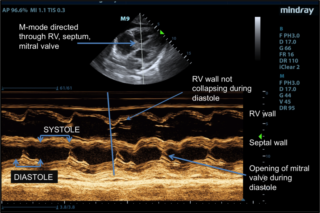 Cardiac Tamponade CCM Daily
